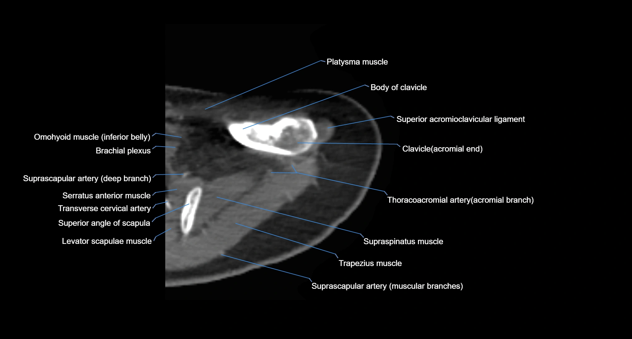 CT Shoulder axial cross sectional anatomy labelled radiology image -00013.webp